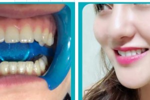 萍鄉(xiāng)龍琪口腔門診部邢超整形價格表附金屬托槽矯正案例展示