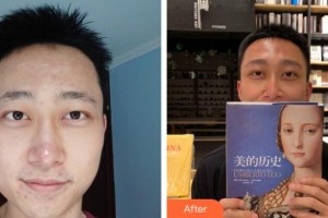 萍鄉(xiāng)龍琪口腔門診部周文濤整形價(jià)格表附種眉毛案例展示