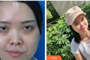 萍鄉(xiāng)星悅醫(yī)療美容診所曹斯頔整形價格表附激光去眼袋案例展示