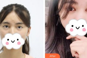 萍鄉(xiāng)市第二人民醫(yī)院眼科陳發(fā)春整形價格表附切開雙眼皮案例展示