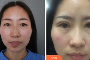 萍鄉(xiāng)市第二人民醫(yī)院眼科徐瓊整形價格表附切開雙眼皮案例展示