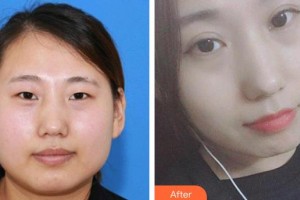 萍鄉(xiāng)市第二人民醫(yī)院眼科汪同祖整形價格表附切開雙眼皮案例展示