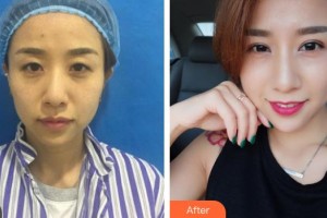 萍鄉(xiāng)市第二人民醫(yī)院眼科徐萍整形價格表附切開雙眼皮案例展示