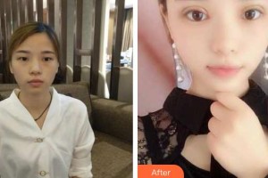 萍鄉(xiāng)薇尚醫(yī)療美容醫(yī)院沈洪元整形價格表附切開雙眼皮案例展示