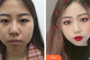 九江協(xié)和瑞美醫(yī)療美容門診部詹領(lǐng)整形價格表附定點雙眼皮案例展示