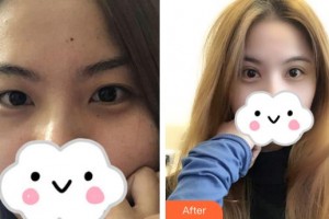 九江臺美整形美容醫(yī)院許言午整形價格表附切開雙眼皮案例展示