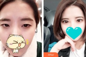 九江市第一人民醫(yī)院整形科趙云杰整形價格表附眼部綜合案例展示