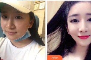 九江市第一人民醫(yī)院整形科宗艷霞整形價格表附切開雙眼皮案例展示