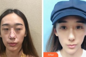 九江協(xié)和瑞美醫(yī)療美容門診部游鵬飛整形價格表附鼻部綜合案例展示