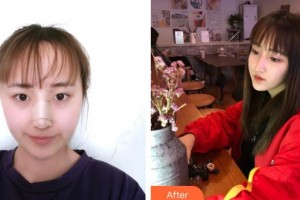 九江協(xié)和瑞美醫(yī)療美容門診部吳偉林整形價格表附鼻部綜合案例展示