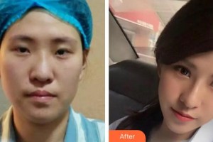 九江圣嘉麗醫(yī)療美容門診部高鵬整形價格表附膨體隆鼻案例展示