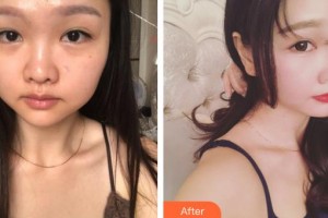 九江瑞麗醫(yī)療美容醫(yī)院張琳琳整形價格表附鼻部綜合案例展示