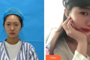 九江汪海峰整形美容醫(yī)院汪海峰整形價格表附鼻部綜合案例展示