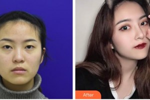 九江唯美醫(yī)療美容門診部胡君整形價格表附鼻翼縮小案例展示