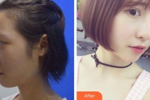 九江市中醫(yī)醫(yī)院眼科余杰為整形價格表附鼻部綜合案例展示