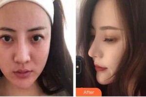 九江愛爾中山眼科醫(yī)院李紅鋒整形價格表附鼻修復(fù)案例展示