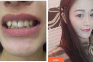 九江奇洋口腔門診部吳揚整形價格表附牙齒隱形矯正案例展示