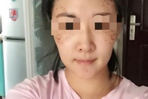 贛州明珠麗格醫(yī)療美容醫(yī)院陳巖青整形價格表附埋線提升案例展示