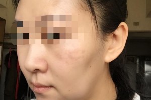 贛州華美醫(yī)療美容門診部馬金萍整形價格表附埋線提升案例展示