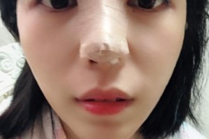 贛州華美醫(yī)療美容門診部吳曉宇整形價格表附隆鼻案例展示