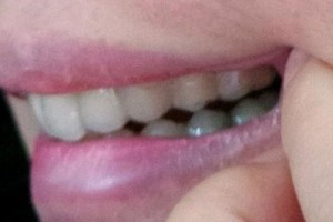 贛州郭君口腔門診部郭君整形價格表附牙齒矯正案例展示