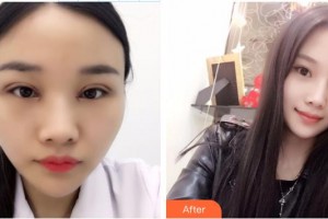 宜春學(xué)院整形美容醫(yī)院彭慶星整形價(jià)格表附眼部綜合案例展示