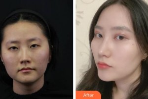 宜春學(xué)院整形美容醫(yī)院白承根整形價(jià)格表附切開(kāi)雙眼皮案例展示