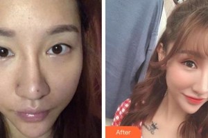 宜春艾萊芙醫(yī)療美容門(mén)診部付曉紅整形價(jià)格表附切開(kāi)雙眼皮案例展示