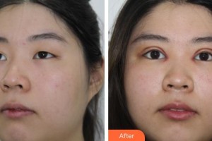 宜春韓美醫(yī)療美容門(mén)診部余志亮整形價(jià)格表附切開(kāi)雙眼皮案例展示