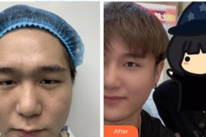 宜春學(xué)院整形美容醫(yī)院周金娟整形價(jià)格表附開(kāi)內(nèi)眼角案例展示