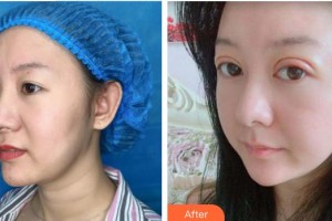 宜春美萊醫(yī)療美容門(mén)診部黃治林整形價(jià)格表附眼部綜合案例展示