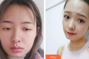 宜春瑞麗整形美容門(mén)診部趙杰發(fā)整形價(jià)格表附切開(kāi)雙眼皮案例展示