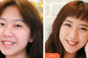 宜春學(xué)院整形美容醫(yī)院曹寒秀整形價(jià)格表附切開(kāi)雙眼皮案例展示