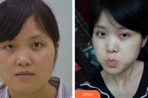 宜春學(xué)院整形美容醫(yī)院彭芳麗整形價(jià)格表附切開(kāi)雙眼皮案例展示