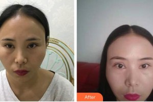 宜春學(xué)院整形美容醫(yī)院張其亮整形價(jià)格表附開(kāi)外眼角案例展示