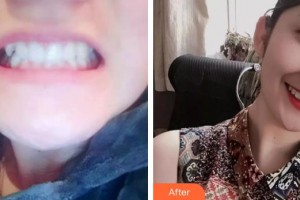 宜春天澤美容醫(yī)院周玲整形價(jià)格表附牙齒陶瓷矯正案例展示