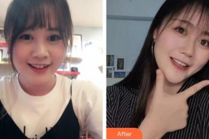 宜春韓美醫(yī)療美容門(mén)診部河范峻整形價(jià)格表附金屬托槽矯正案例展示