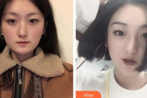 宜春愛(ài)爾眼科醫(yī)院張忠勝整形價(jià)格表附定點(diǎn)雙眼皮案例展示