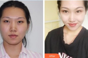 宜春愛(ài)爾眼科醫(yī)院周益龍整形價(jià)格表附眼部綜合案例展示