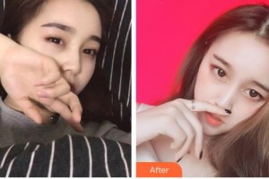 宜春愛(ài)爾眼科醫(yī)院鄢濤整形價(jià)格表附眼部綜合案例展示