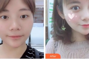 宜春愛爾眼科醫(yī)院任旋整形價格表附切開雙眼皮案例展示