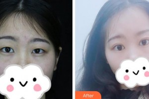 宜春愛爾眼科醫(yī)院周愛云整形價格表附切開雙眼皮案例展示
