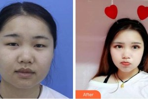 宜春愛爾眼科醫(yī)院楊甜整形價格表附切開雙眼皮案例展示