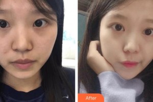 撫州美萊爾醫(yī)療美容門診部斯樓斌整形價格表附切開雙眼皮案例展示