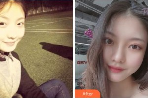 上饒尚美醫(yī)療美容門診部周敏整形價格表附開內(nèi)眼角案例展示