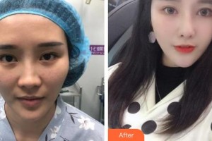 上饒平安醫(yī)院醫(yī)療美容科劉家榮整形價格表附下瞼整形案例展示