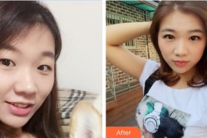 上饒平安醫(yī)院醫(yī)療美容科方五華整形價格表附眼部綜合案例展示