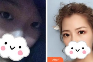 上饒平安醫(yī)院醫(yī)療美容科董芳整形價格表附眼部綜合案例展示