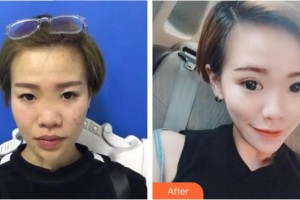 上饒平安醫(yī)院醫(yī)療美容科鄭黎敏整形價格表附眼部綜合案例展示