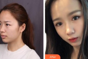 上饒市人民醫(yī)院燒傷整形外科徐湯靈整形價格表附眼部綜合案例展示